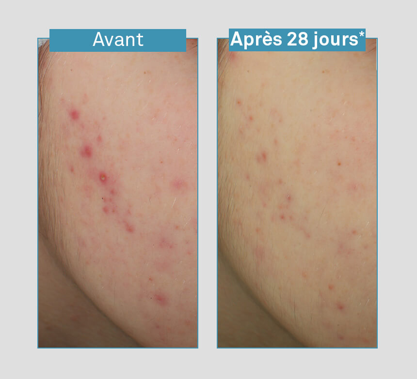 serum-anti-imperfecties